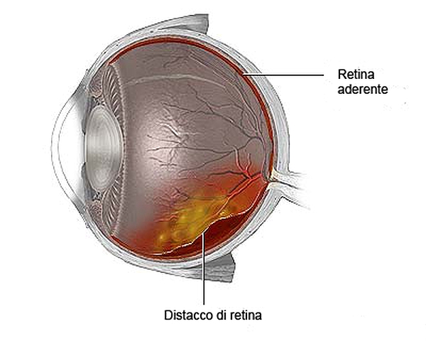salusottica-Distacco-retina-01 distacco retina Torino