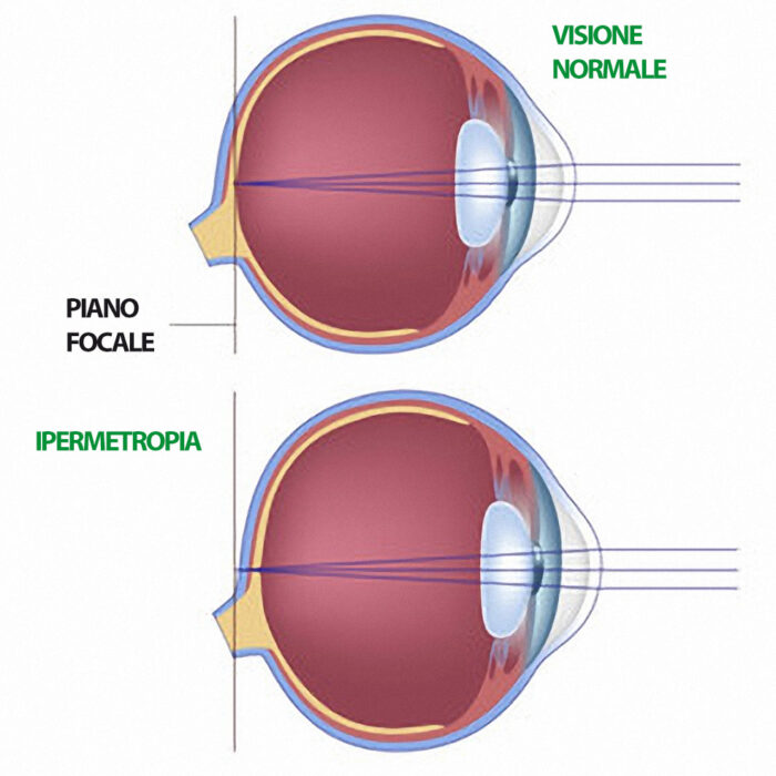 ipermetropia Torino